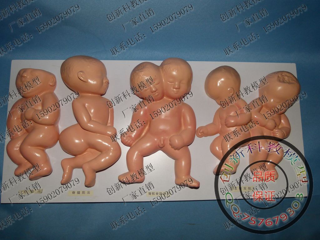 畸形胎儿模型 畸形婴幼儿演示教具 人体模型 连