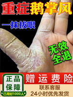 治疗鹅掌风特效药手掌脱皮干裂真菌感染角质层，增厚止痒抑菌专用膏