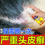头皮癣药膏真菌感染去头皮屑毛囊炎脂溢性皮炎银屑病痘结痂喷雾剂