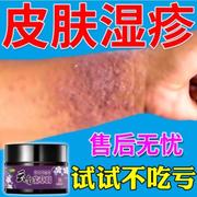 皮肤湿疹止痒去大腿内侧根真菌感染汗疱干燥瘙痒急慢性抑菌紫草膏