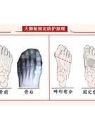 大脚拇指拇外翻矫正器甲沟脚趾套骨折固定器护具脚受伤打石膏保护