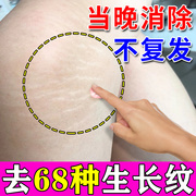 肥胖纹修复霜消除去肥胖纹去除产后妊娠纹，大腿纹生长纹路淡化神器