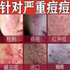 青春痘特效药青春痘去痘女初中生玫瑰青春痘药膏淋巴痘腮边痘