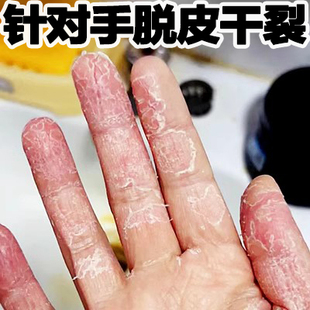 手脱皮严重专用干裂脱皮真菌感药膏季节性手，裂纹干燥粗糙起皮