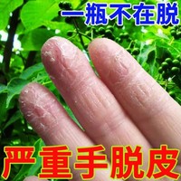治疗手脱皮的药膏真菌，感染手指头手部鹅掌风干裂手癣，修复汗疱疹膏