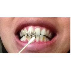 牙齿美白牙贴速效去除黄牙烟渍氟斑牙变白去黄洁白洗牙液清洁神器
