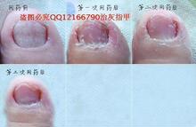 灰指甲(软化膏3G+10ML生甲液+刀片+胶布)灰指甲49元1个灰指甲