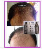 发之易 与你见证脱发再生奇迹，真人图照生发效果看得见！