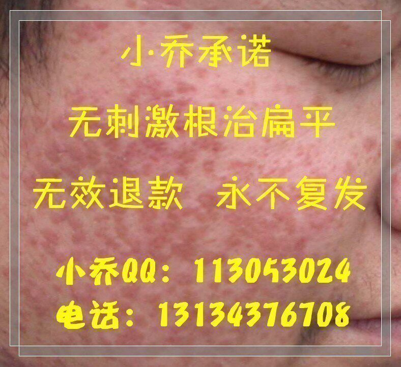 ��Ч�˿�������ԣ���Ч����ҩ�޴̼�ȥ�����Ʊ�ƽ��ר�β�����