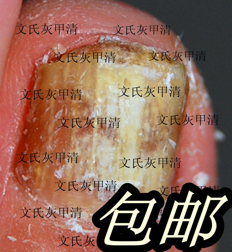 <span class=T>好评排行</span>第1名:灰<span class=H>指甲</span>专用特效药软甲膏亮甲美甲刀磨砂<span class=H>指甲</span><span class=H>油</span>套装假<span class=H>指甲</span>护理包邮