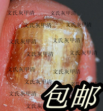灰指甲专用特效药脚气特效药复生液亮甲灰指甲药无效退款超强效果