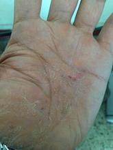 护肤极品!孕妇宝宝婴儿可用 <em>湿疹</em> <em>奶癣</em> 瘙痒过